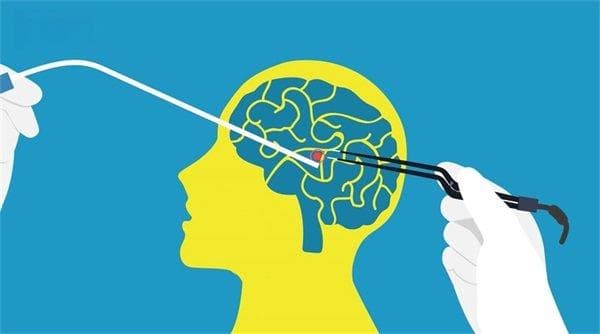 垂体瘤残留二次手术还是伽马刀好