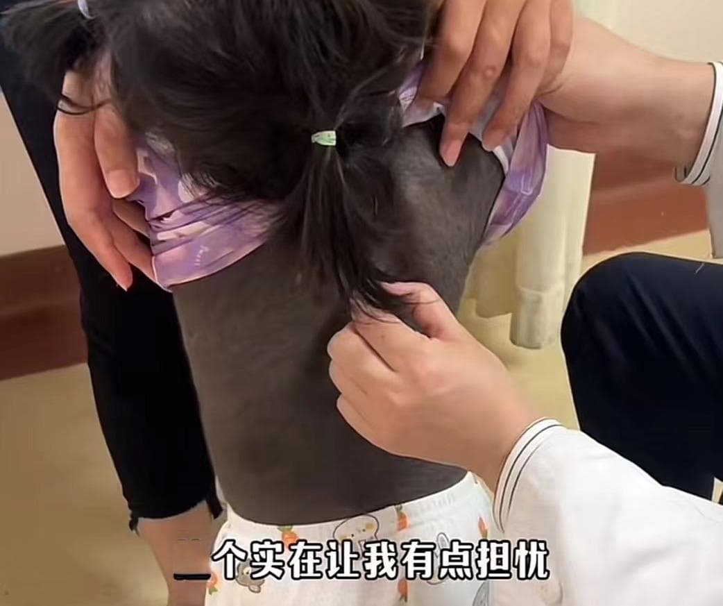 2岁患儿后背长满黑痣，医生：太少见了！
