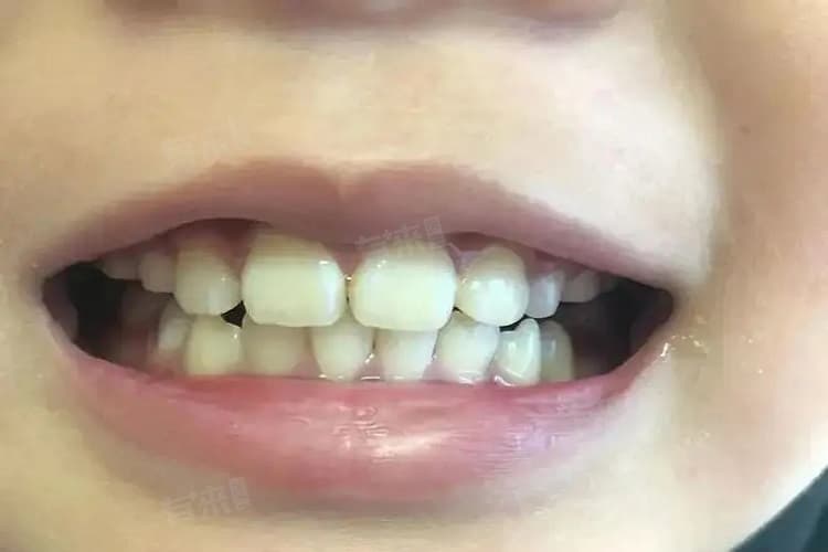 牙齿咬合不正怎么矫正