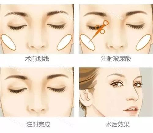 玻尿酸祛皱原理是什么？通过填充提升皮肤组织，用于法令纹/鼻唇沟/眼周等部位