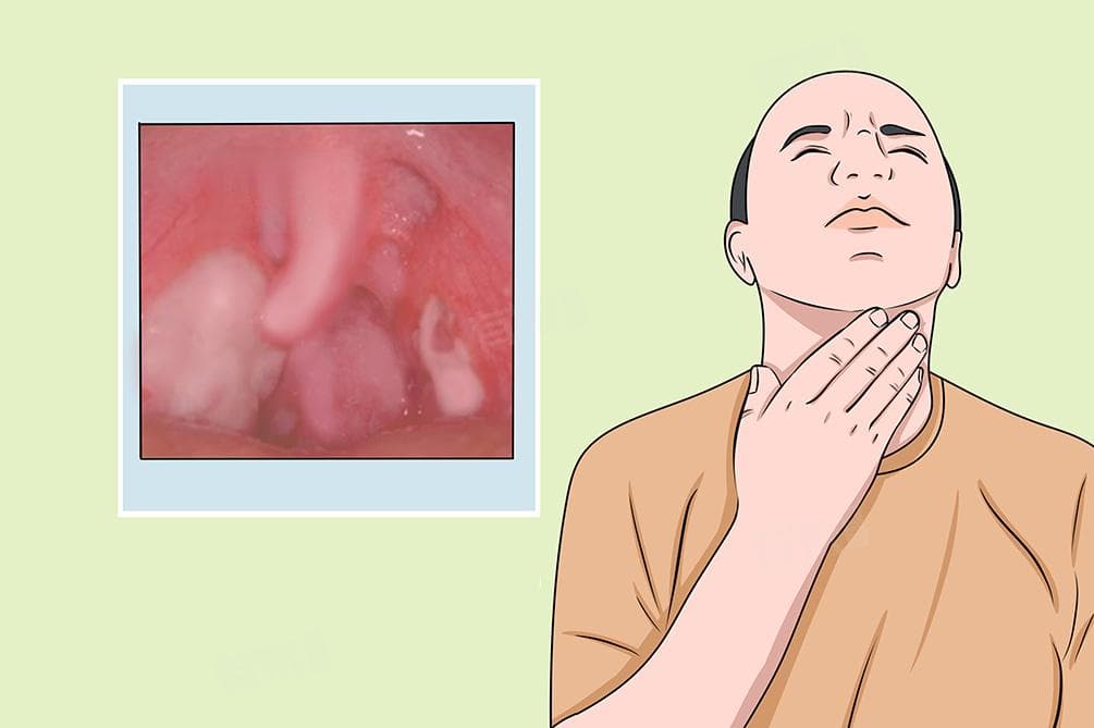 喉咙里有痰吐不出来吞不进去怎么办