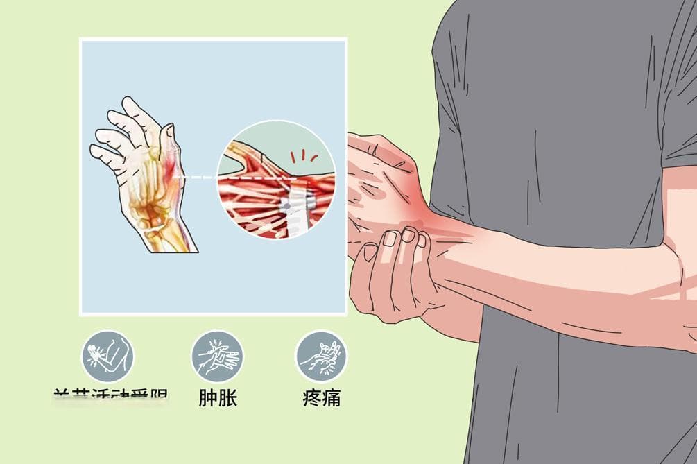 腱鞘炎3个动作自愈方法