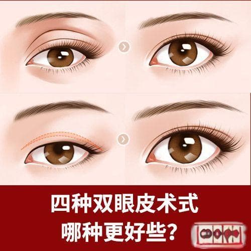 欧式重睑术效果维持时间？专业医生详解手术后护理和风险！