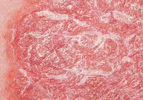 牛皮癣是否具有传染性？专家解读其病因与治疗