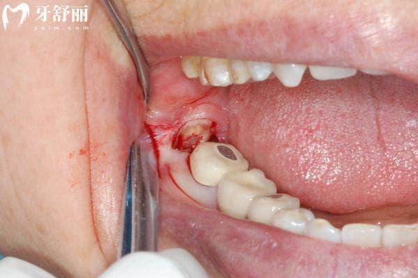 拔牙后如何帮助伤口愈合？拔牙后饮食指南/注意事项奉上详解