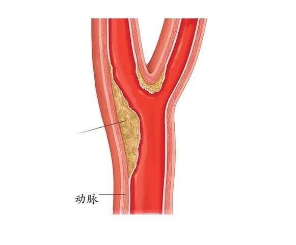 颈动脉斑块有什么影响？如何防治？