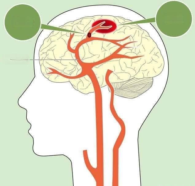 手麻怎么办？专家解析手麻原因及就诊指南