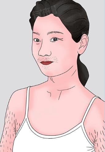 体毛旺盛是什么原因