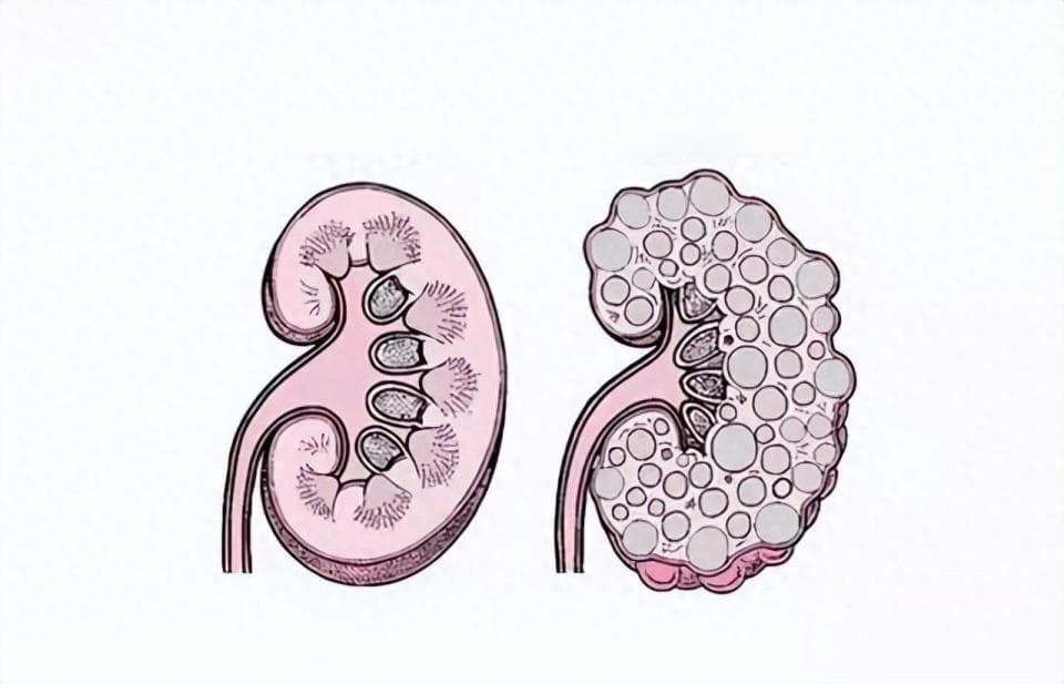 得了多囊肾怎么办？如何治疗多囊肾病？日常做好7个管理
