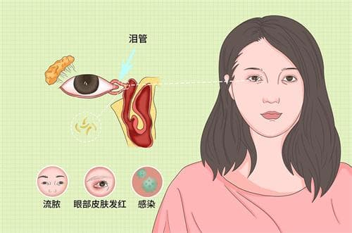 泪小点栓塞术全攻略：有用与否、手术操作步骤、价格大起底