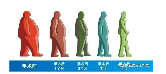 减重手术全指南：你想知道的都在这里！