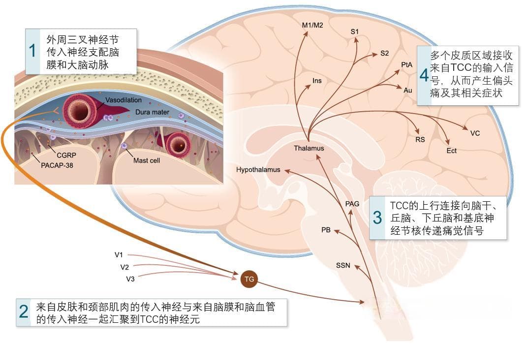 偏头痛：从科学发现到现代医学的理解