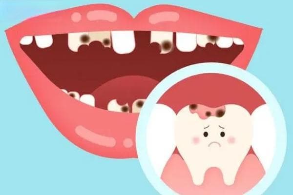 为什么邻面龋一定要补？邻面龋一下坏两个，要注意！