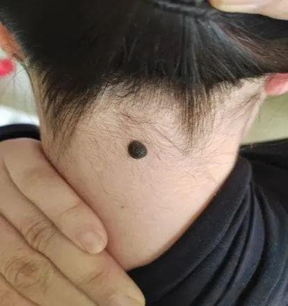 芸芸众生，人各有“痣”，认识色素痣