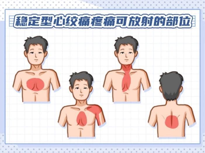 痛在胸中，急在心头：识别并应对不同类型的胸痛
