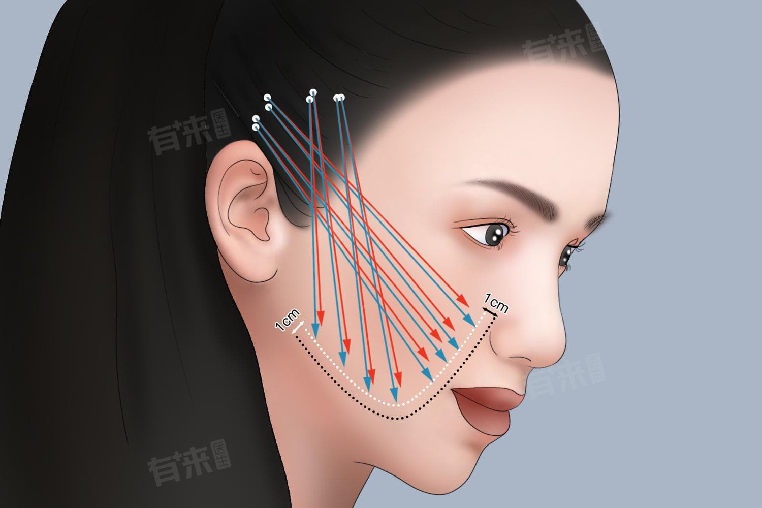面部轮廓提升哪种效果最好