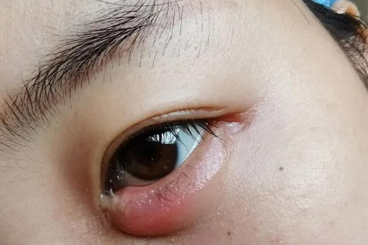下眼皮又肿又痛？五种原因及应对方法全解析