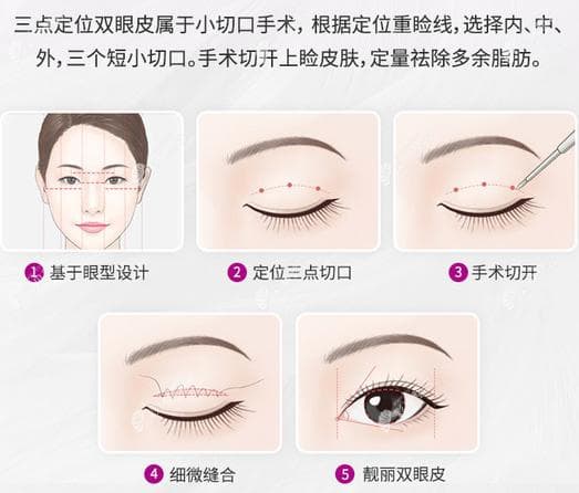 从小切口双眼皮和全切双眼皮的区别判断它们哪个好