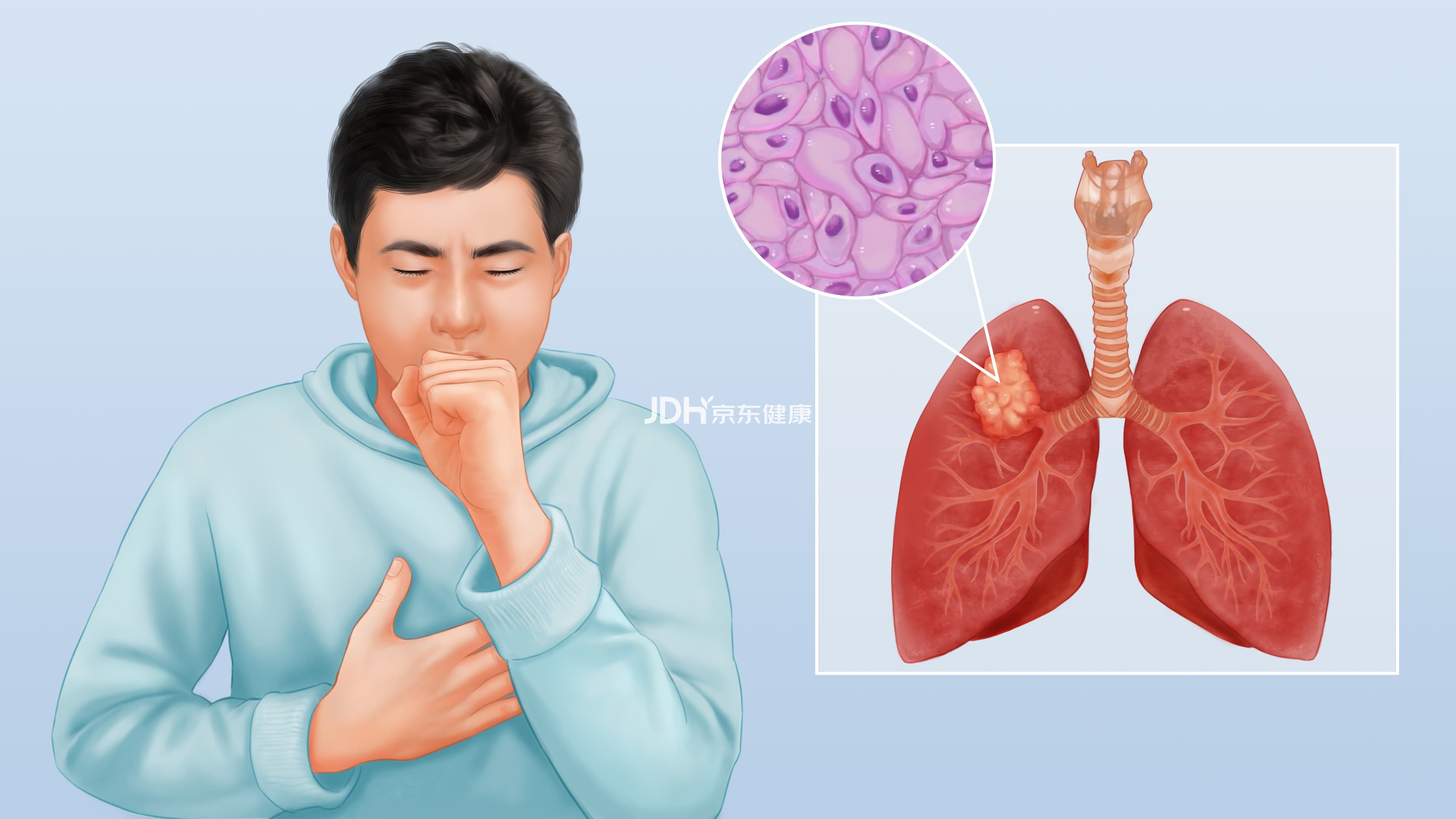 肺鳞癌：病因、症状、诊断与治疗全解析