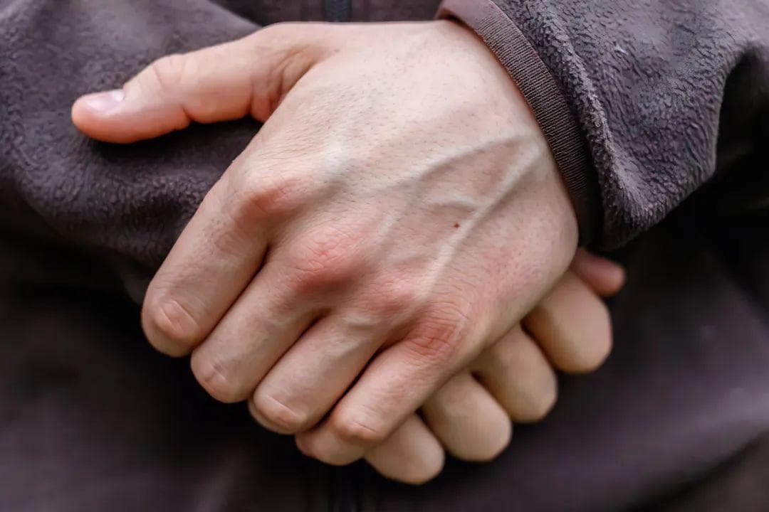 为什么有的人手上青筋暴起？这些地方出现青筋，一定要小心！