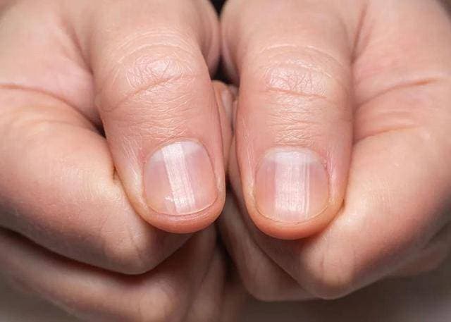 指甲没有“月牙”、出现竖纹，说明身体已经不健康了？一文说清