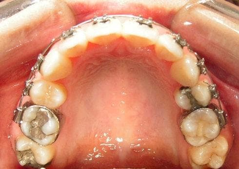 正颌手术全解析：适应症、手术过程及术后护理
