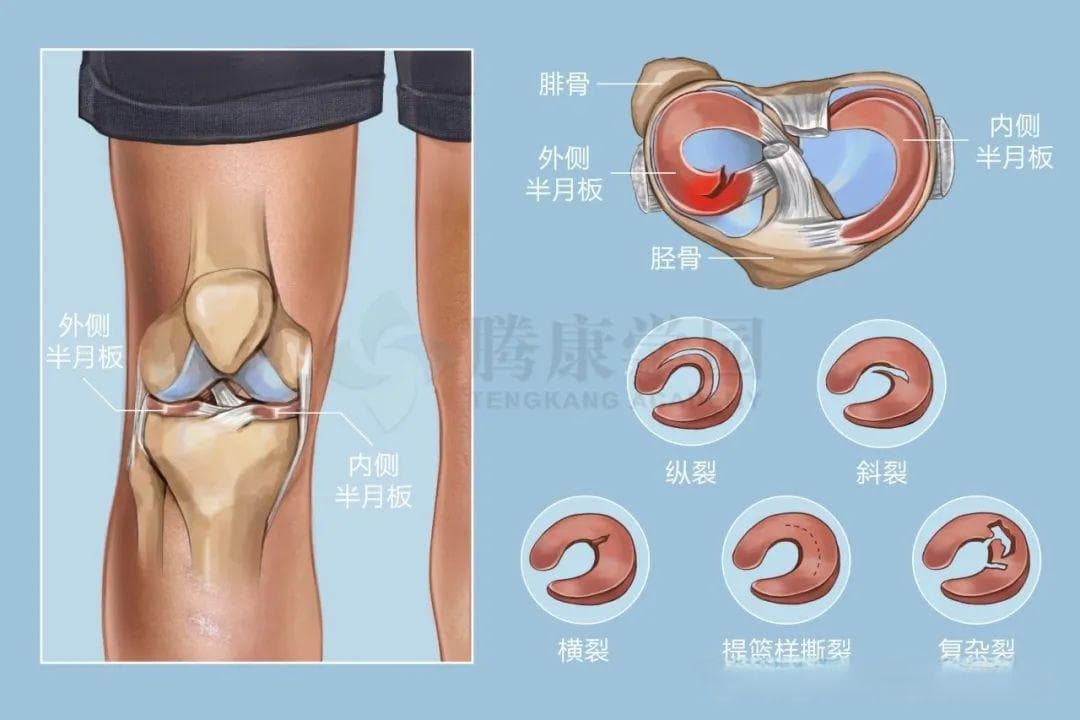半月板：膝关节的“守护神”