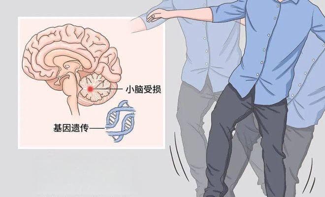 共济失调的症状、原因与治疗全解析