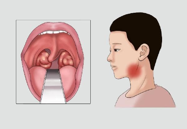 扁桃体发炎时的忌口水果及注意事项