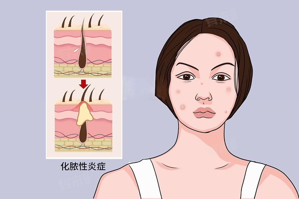 毛囊炎是什么？病因、症状与预防全解析