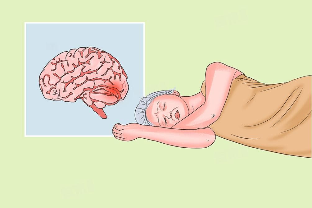 癫痫的症状表现及预防方法