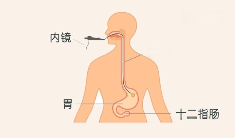 3分钟看懂：胃镜检查如何做？胃镜报告怎么看？