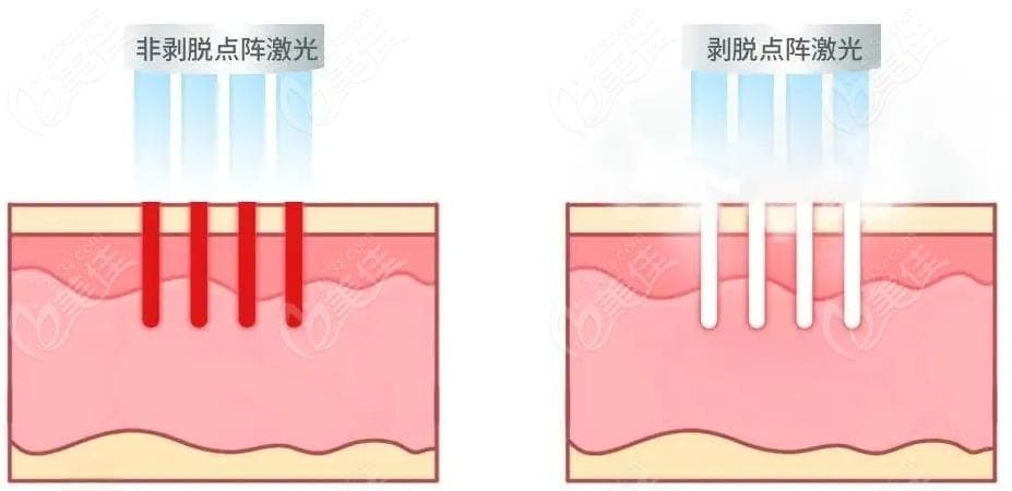 点阵激光VS光子嫩肤：谁才是祛痘印的真正神器？