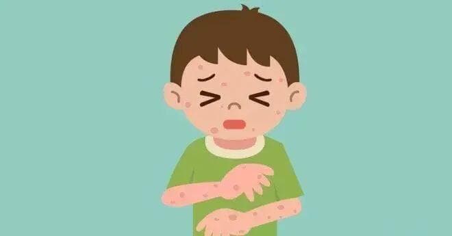 解密荨麻疹：症状、诱因与防治全攻略