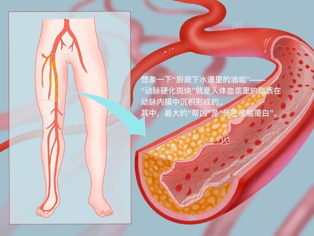 一走路就腿痛？警惕这里被“油堵死”！已有年轻人中招