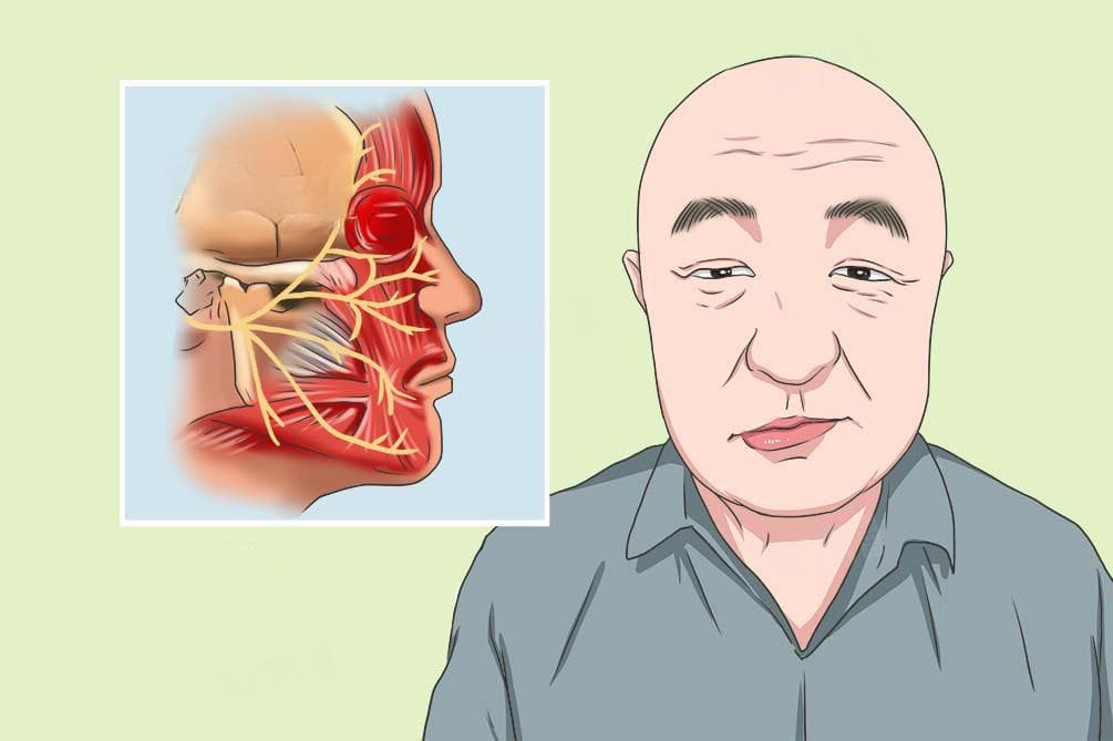 面瘫快速恢复的方法
