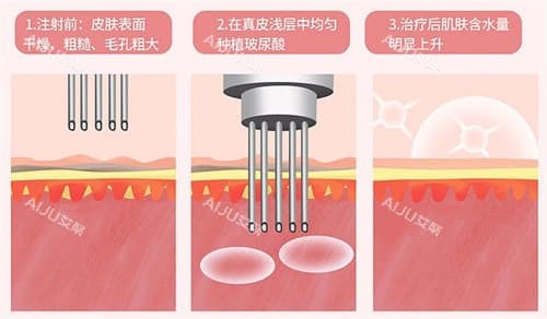 滚针水光和注射水光哪种好？从各自的原理/优点/维持时间/价格等方面对比