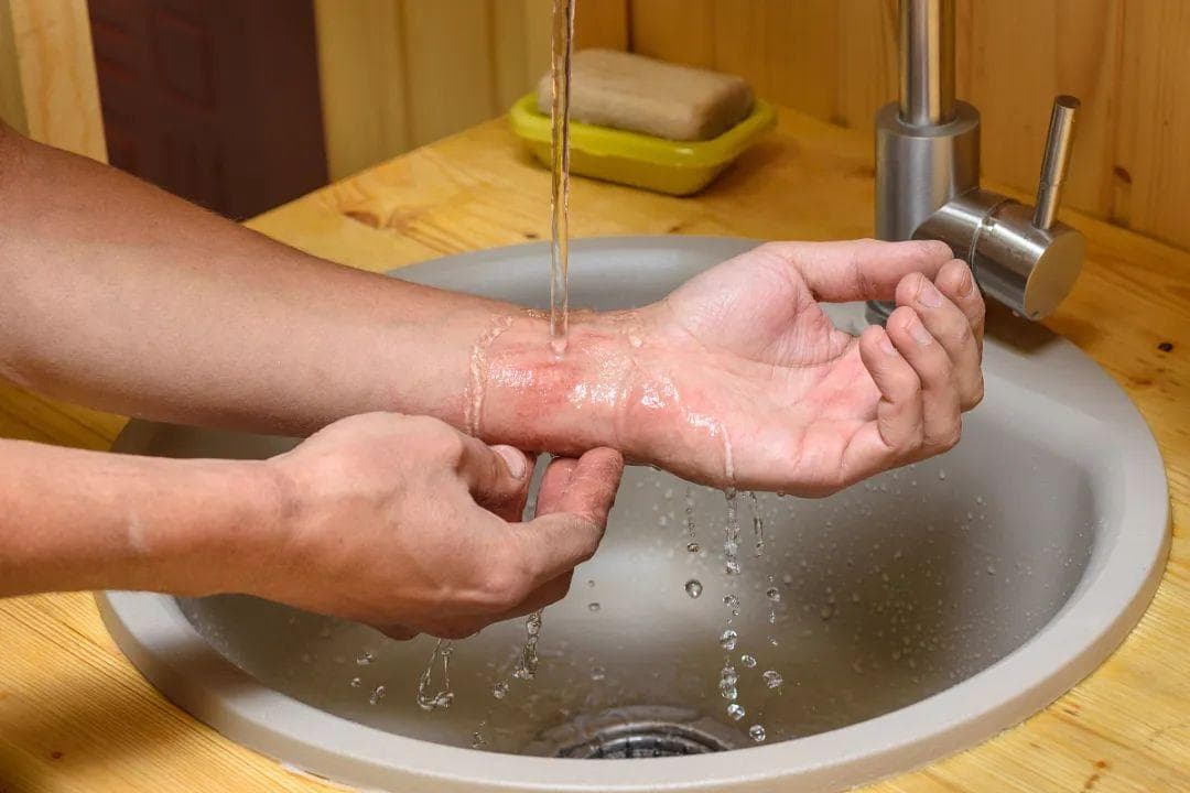 伤口可以碰水吗？一文读懂伤口护理要点
