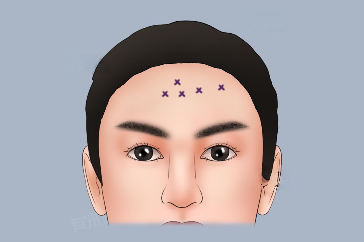 男性如何去除抬头纹