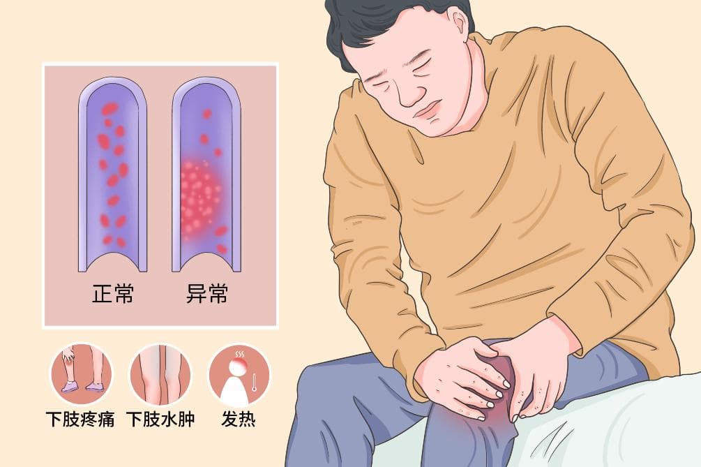 下肢静脉血栓的预防措施