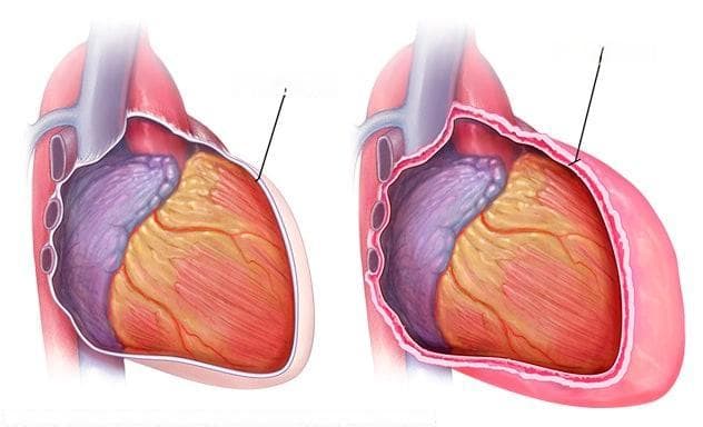 心肌梗死后综合征：症状、病因及预防