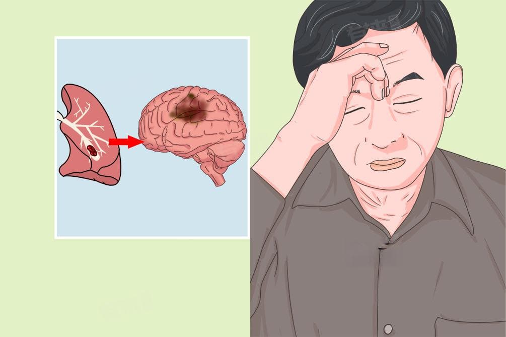 肺性脑病：定义、症状、治疗与预防全解析