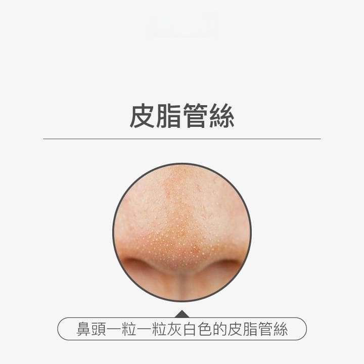 皮脂管丝是什么？别再误会黑头粉刺！专家推荐3招改善皮脂管丝