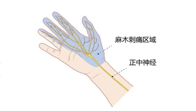 “鼠标手”折磨人，该如何应对？