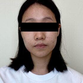 29歲女臉部狂生暗瘡 月經前更嚴重！中醫調理半年回復光滑 附紓緩茶飲