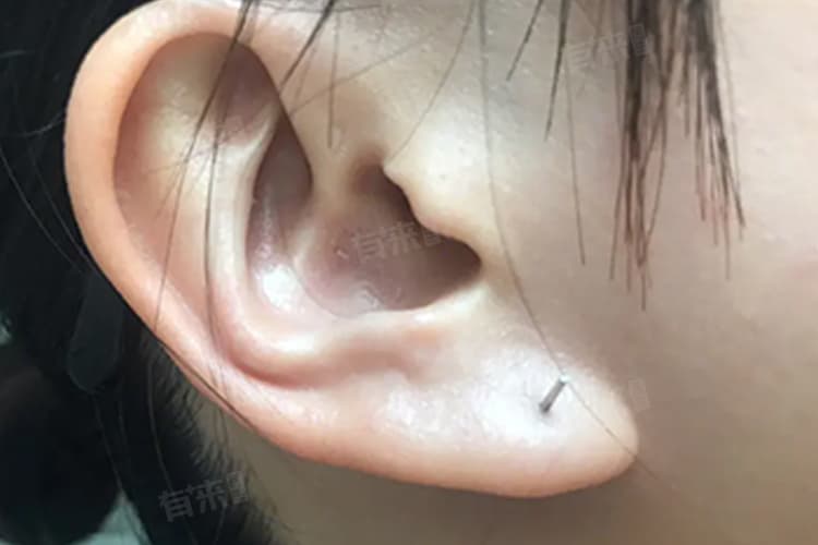 养好一个耳洞要多久