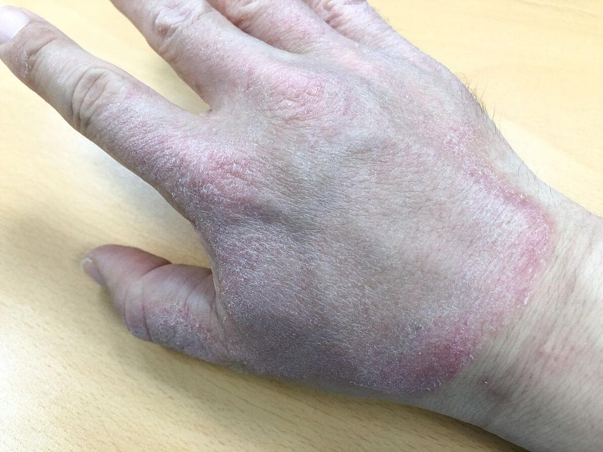 湿疹用什么药膏最有效？一文详解各类湿疹药膏