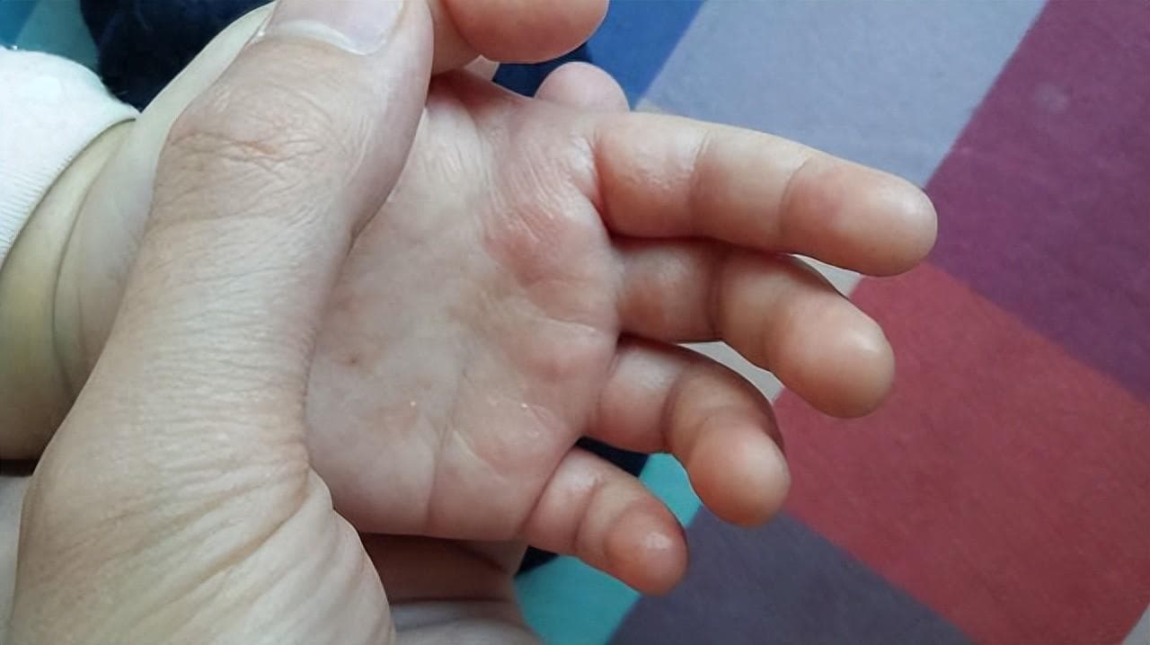 宝宝手掌心发红发热，是生病了吗？什么情况下要去看医生？