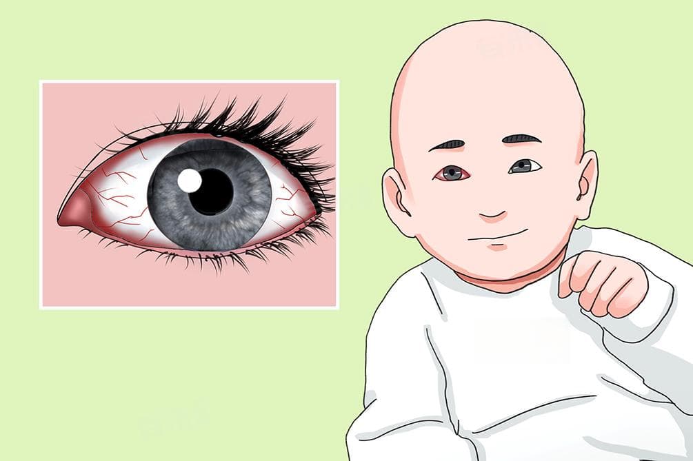 新生儿眼底筛查怎么做