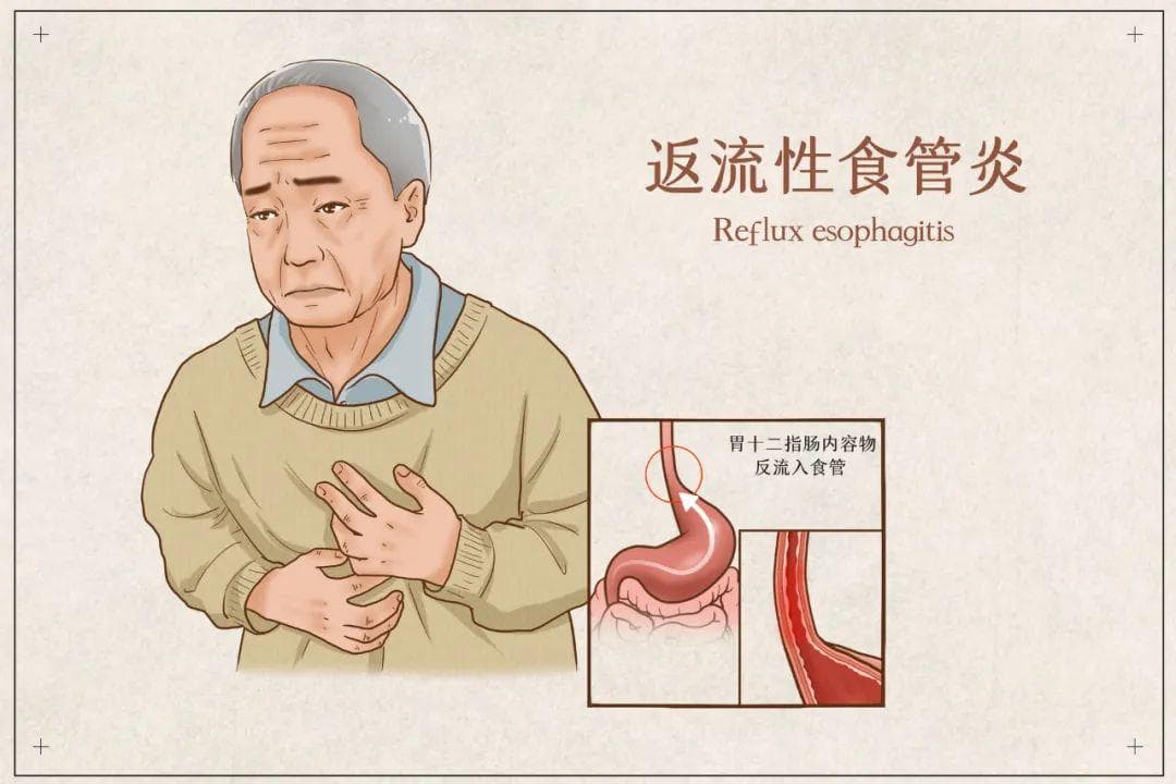 有一种生不如死，叫“反流性食管炎”